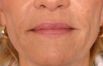 Hyaluronic Acid After